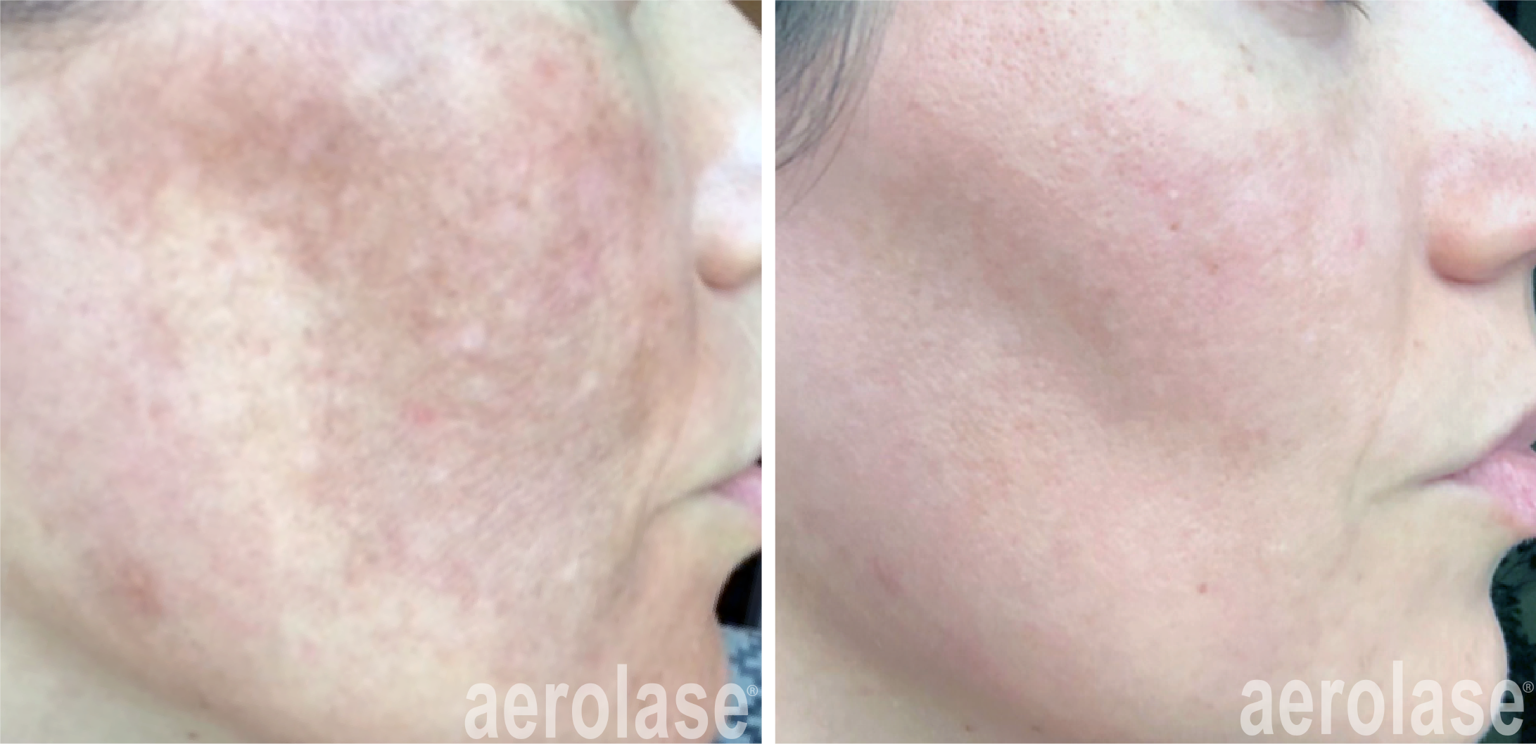 Aerolase Laser HydraSkin Medi Spa